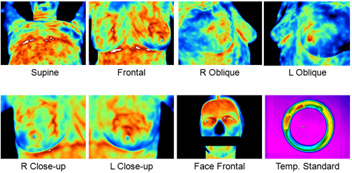 Breast Thermography View Protocol